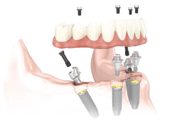 all on four dental implants in Atlanta, GA